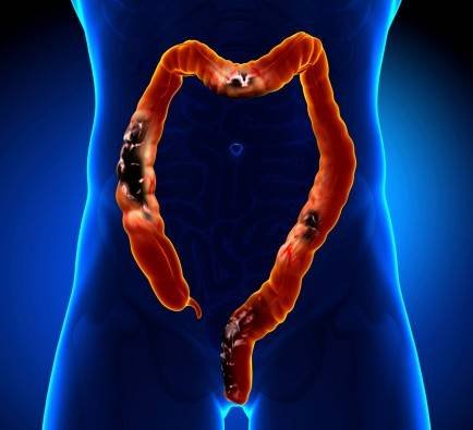 DIVERTICULOSIS VS DIVERTICULITIS
